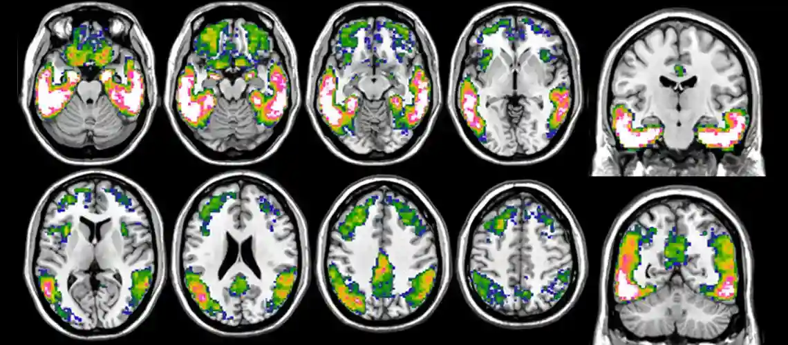 Tau-Imaging-With-18F-Flortaucipir-PET-in-Alzheimers-Disease.webp